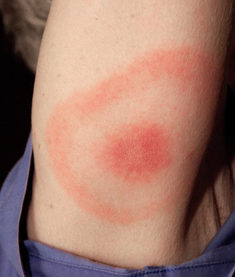 Rød ring med lysere midte på overarmen — klassisk borreliautslett