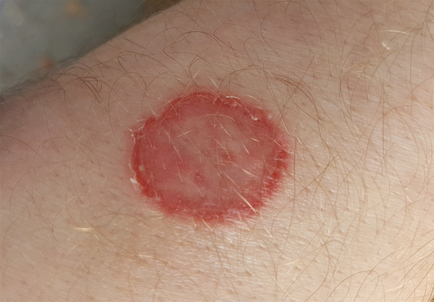 Rund, rød flekk med hevet kant og lysere midte på underarm