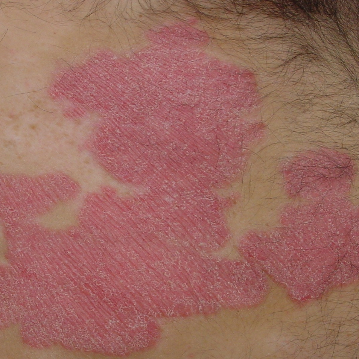 Flere avgrensede psoriasisplakk på overkroppen