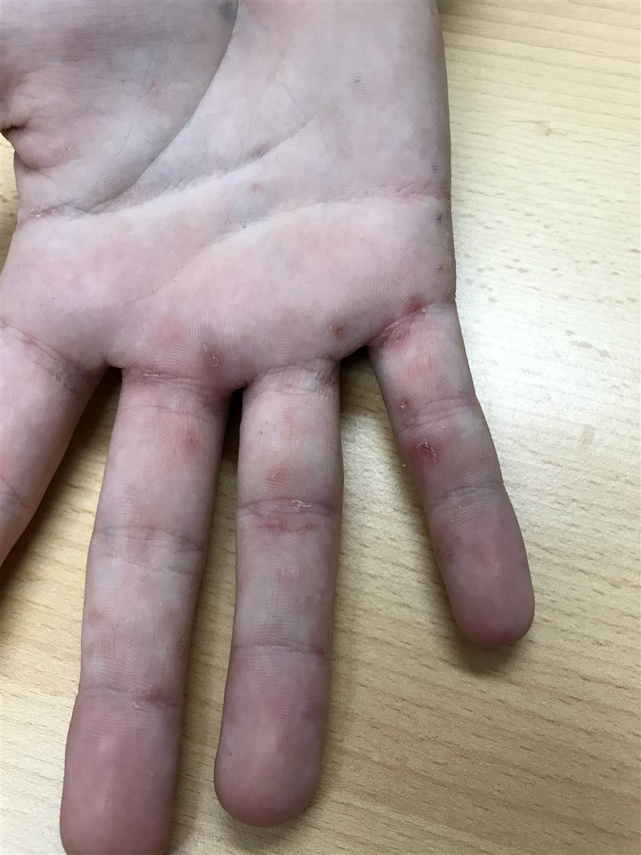 Skabbutslett mellom fingrene